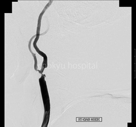 PRE STENT��������